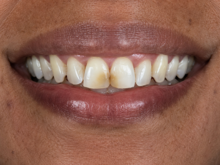 Paciente avaliando faceta de resina e estética dental em consultório odontológico em Campinas